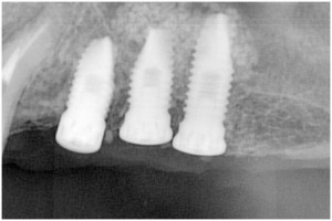 杉山4　左上56サイナスリフト・拡大写真